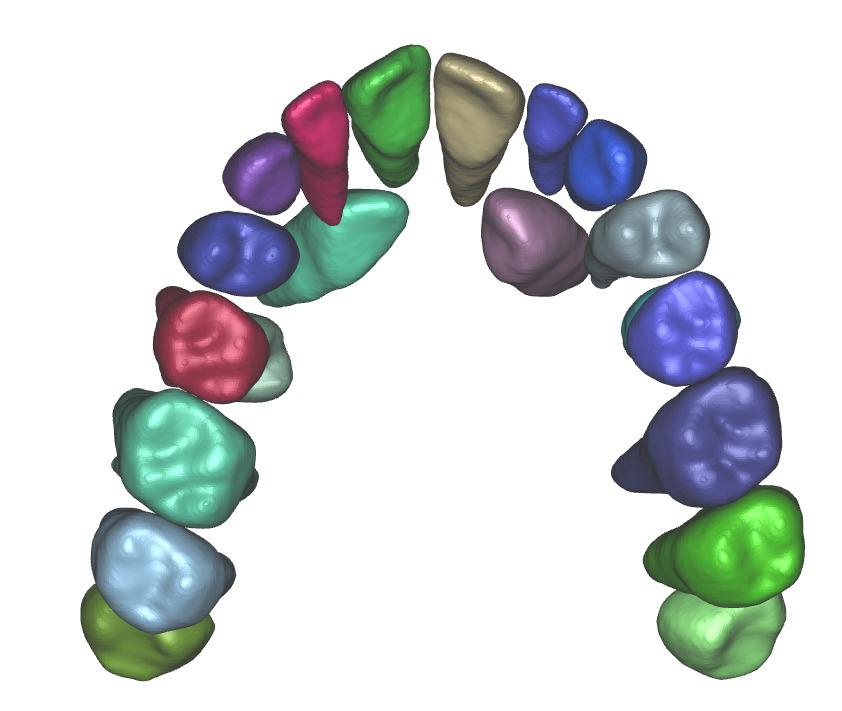 A digital scan of a dental arch with each tooth mapped and colour coded individually, the kind of model a series of aligners is planned from.