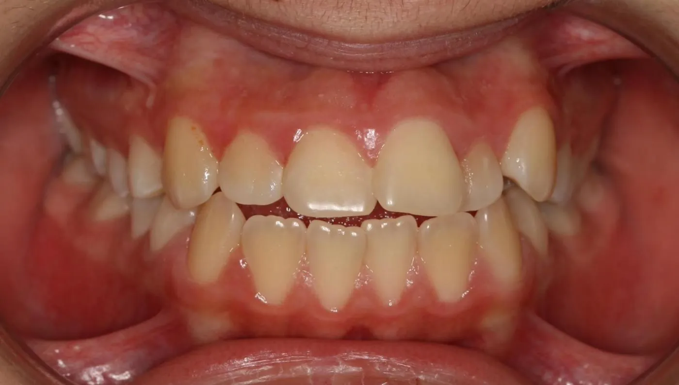 Before treatment: Crowding