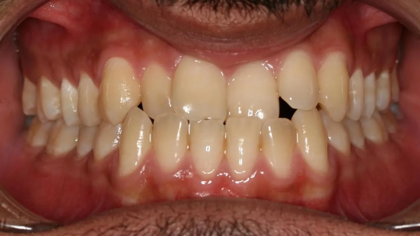 Before treatment: Crowding