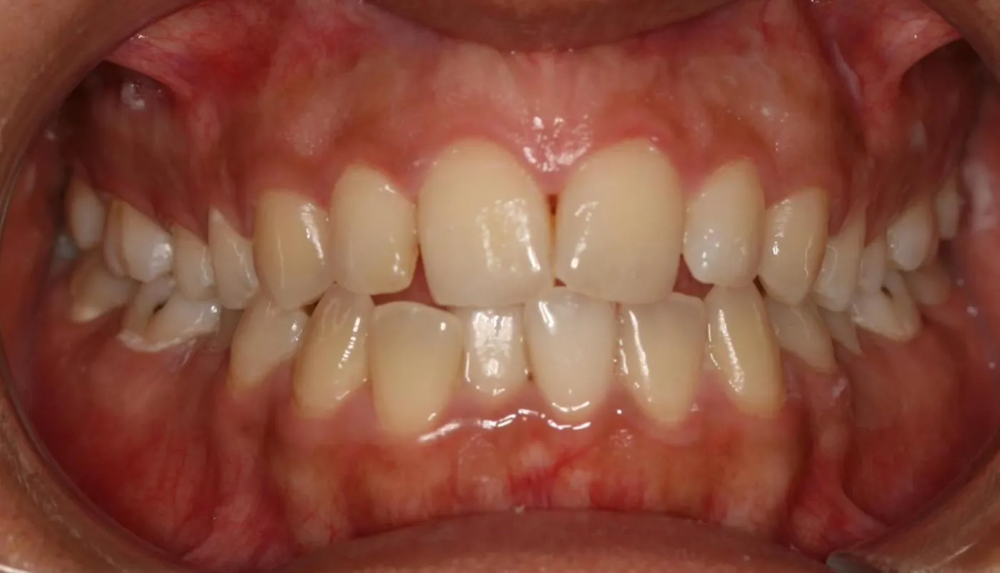 Before treatment: Crowding