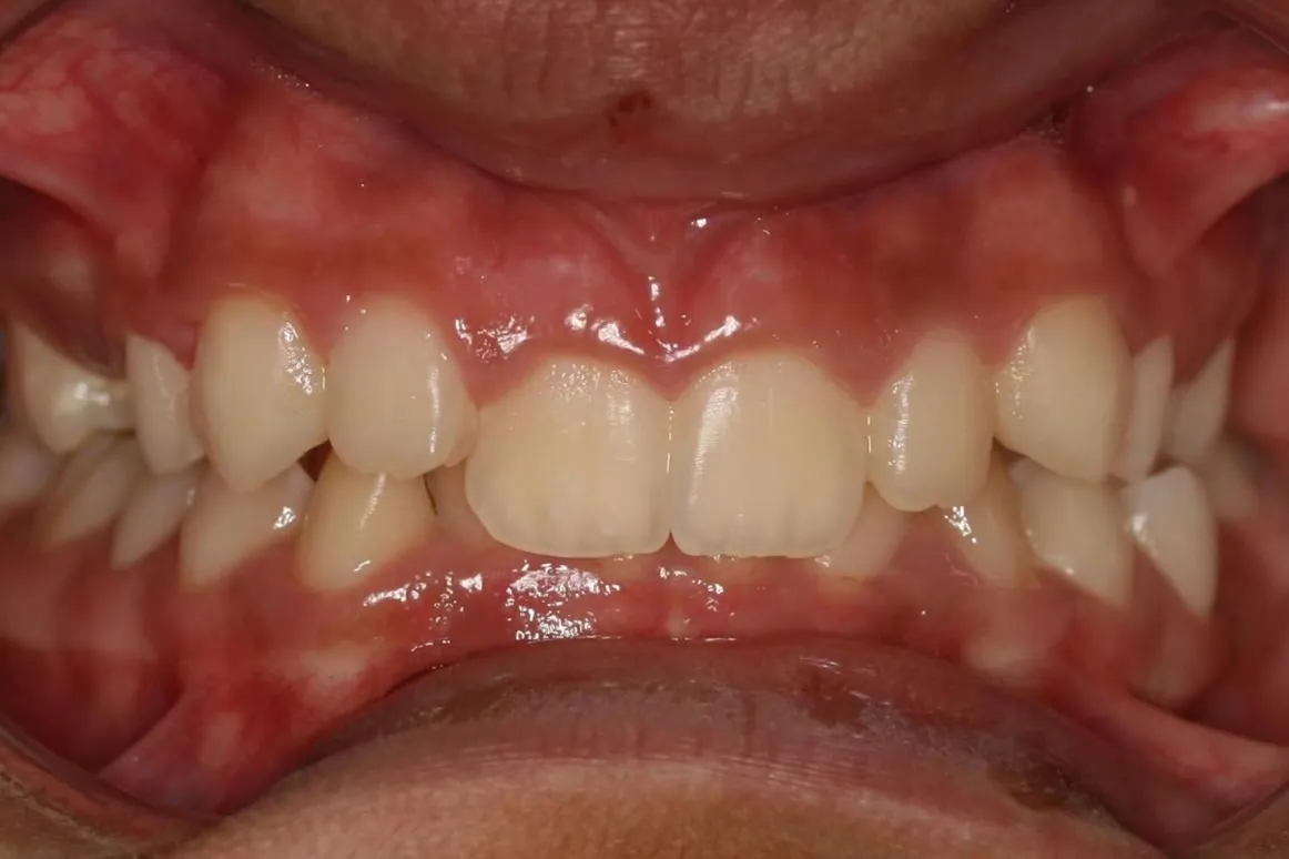 Before treatment: Crowding