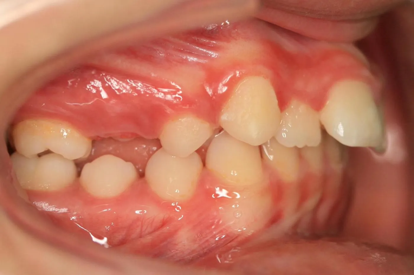 Before treatment: Crowding
