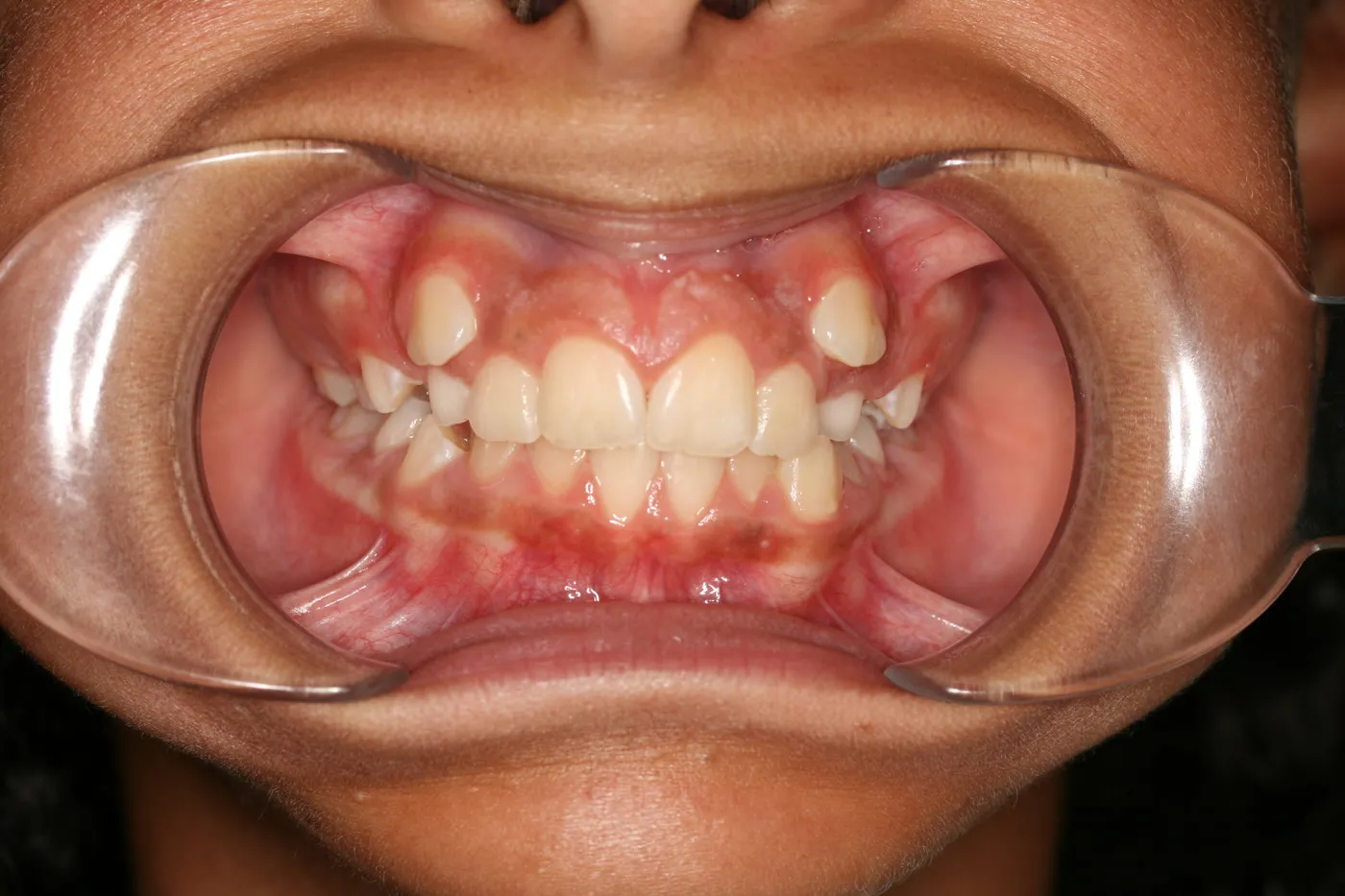 Before treatment: Crowding