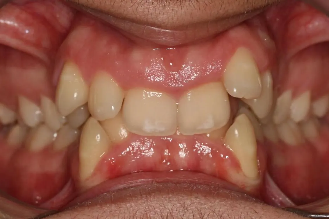 Before treatment: Crowding