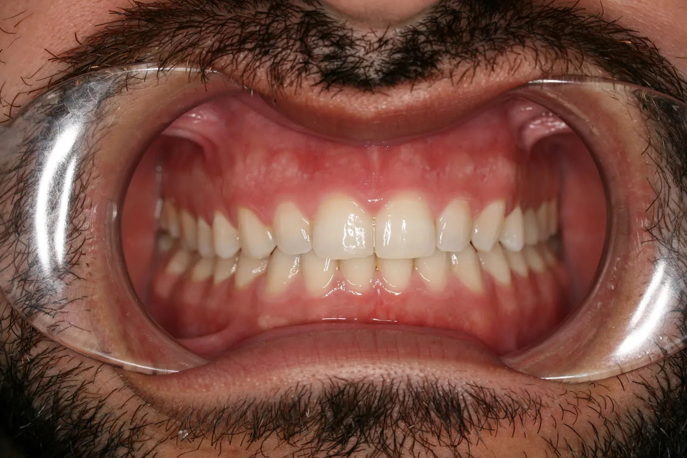 After treatment: Spacing