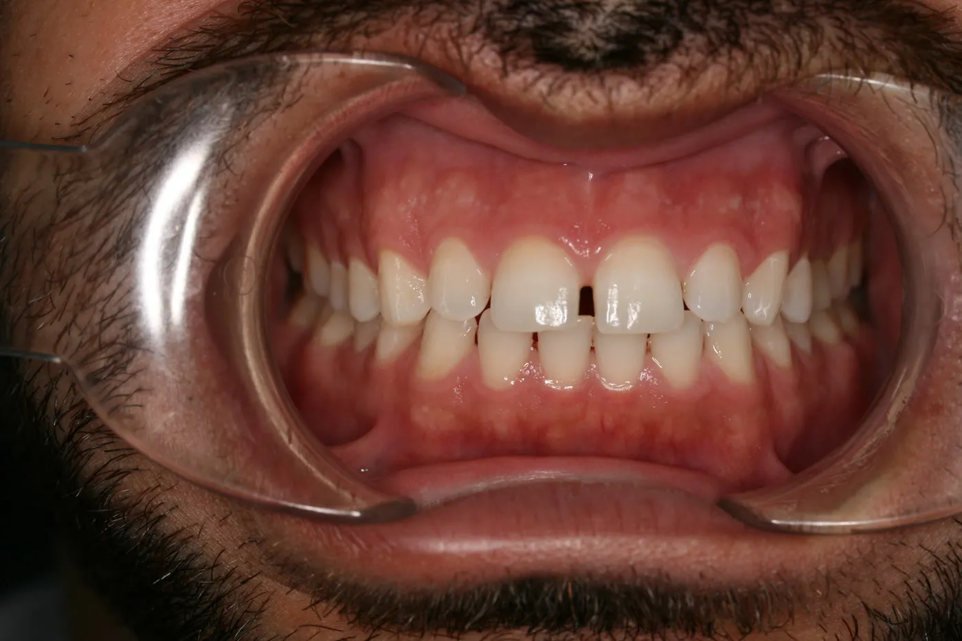 Before treatment: Spacing