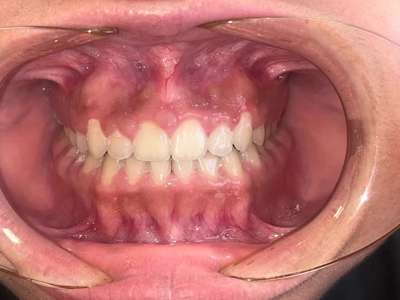 After treatment: Spacing