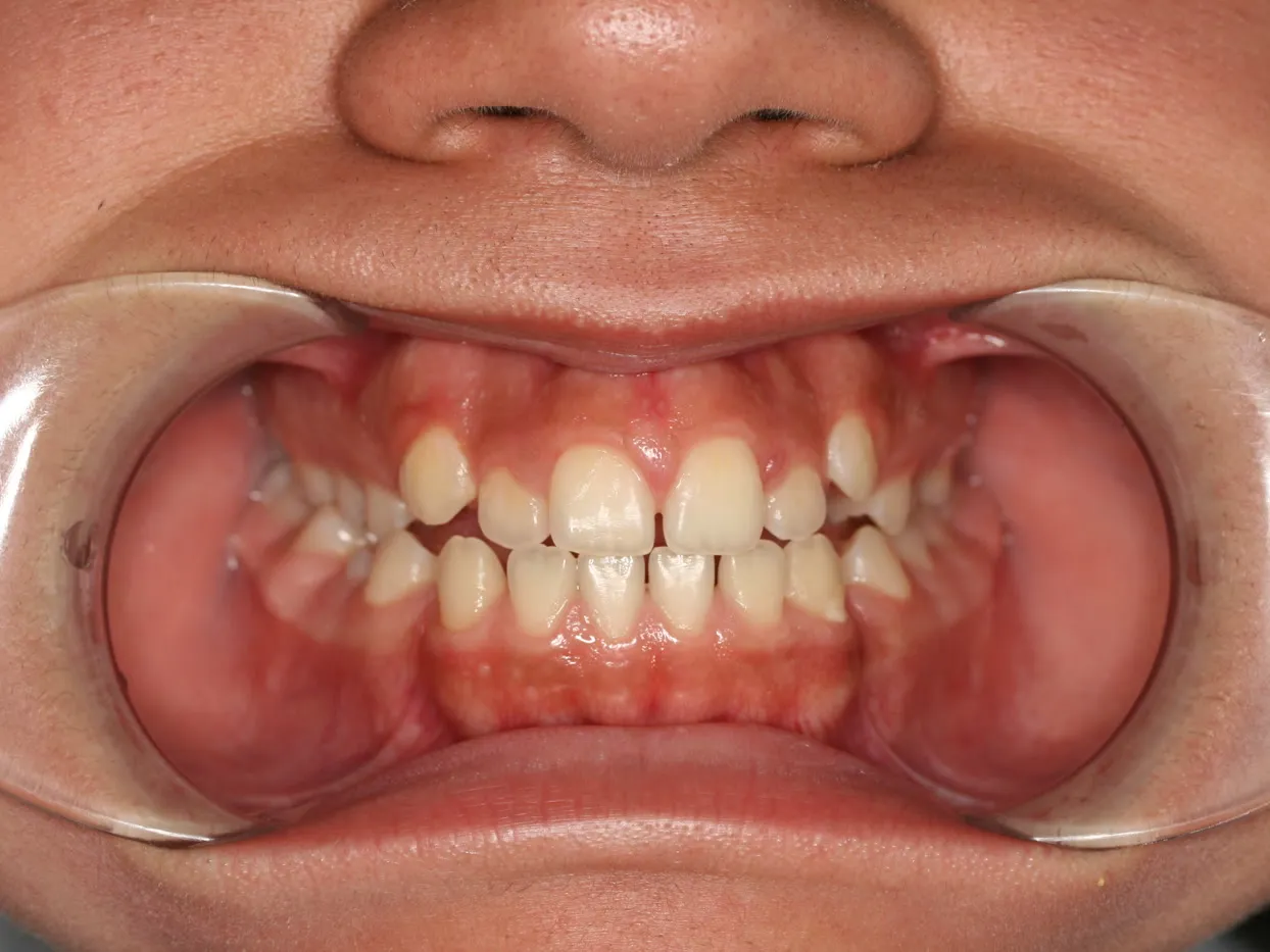 Before treatment: Spacing