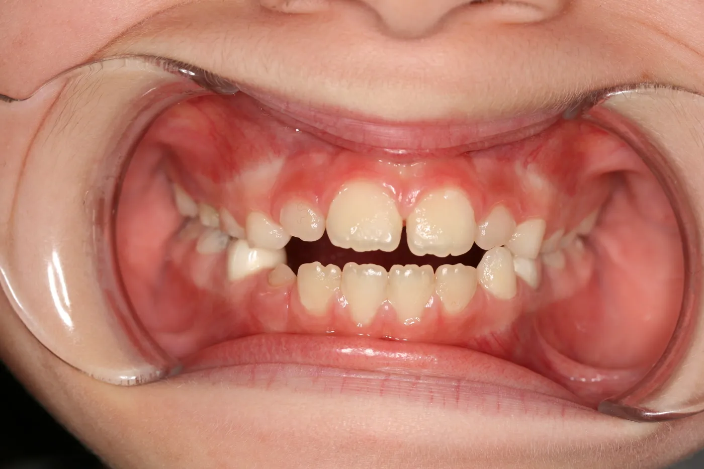 After treatment: Spacing