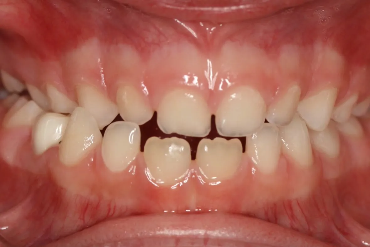 Before treatment: Spacing
