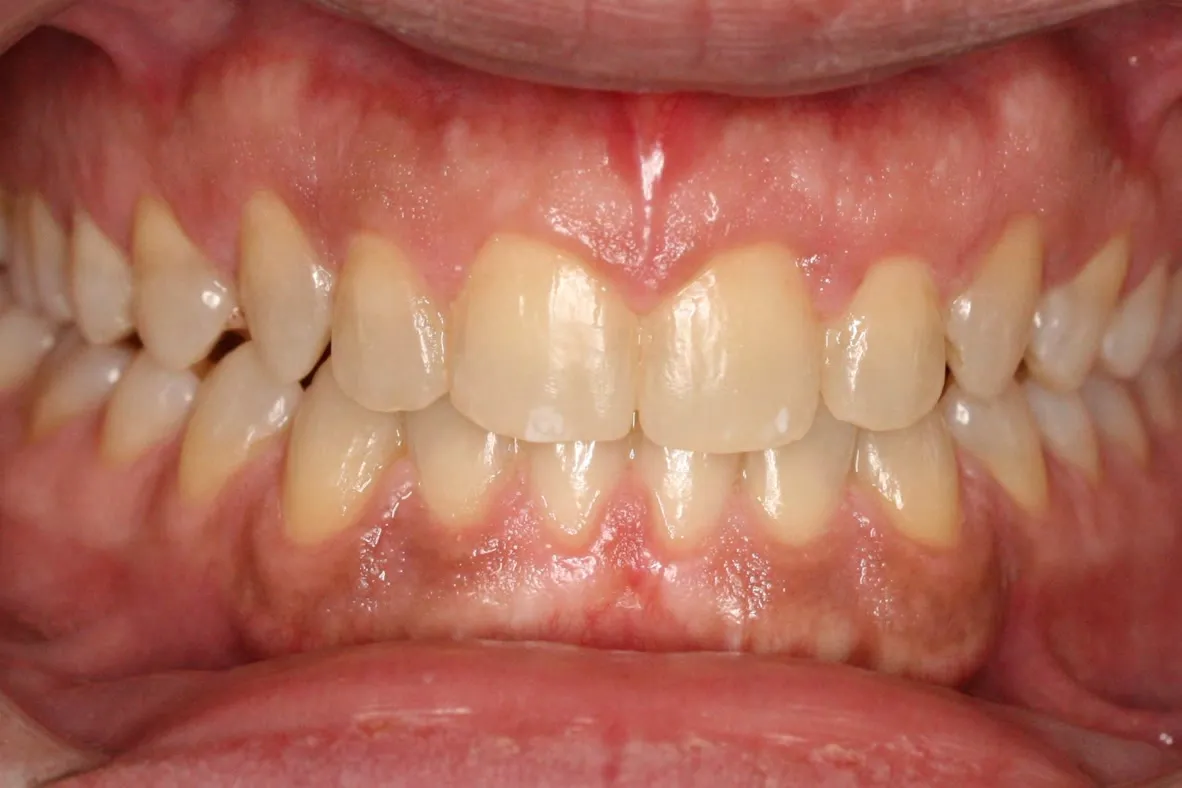 After treatment: Spacing