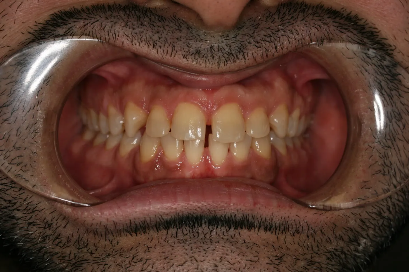 Before treatment: Spacing