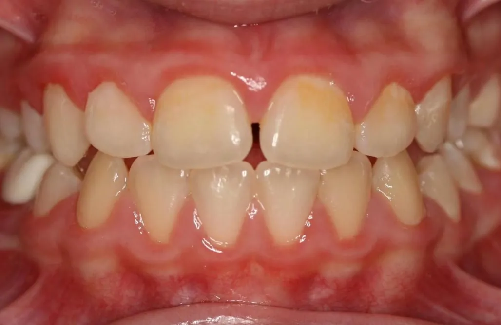 After treatment: Spacing