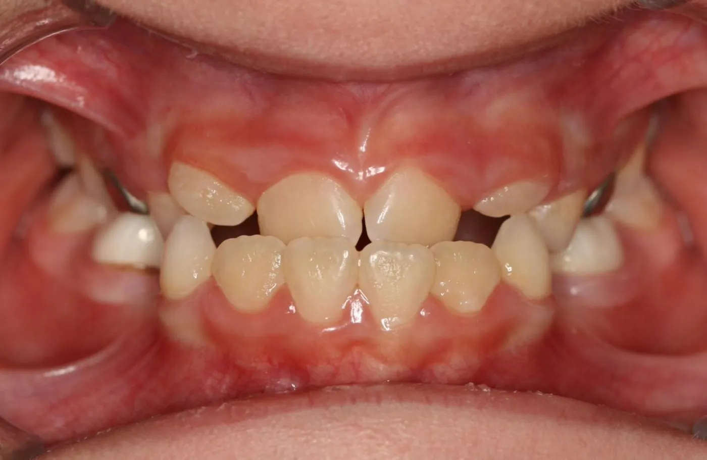 Before treatment: Spacing