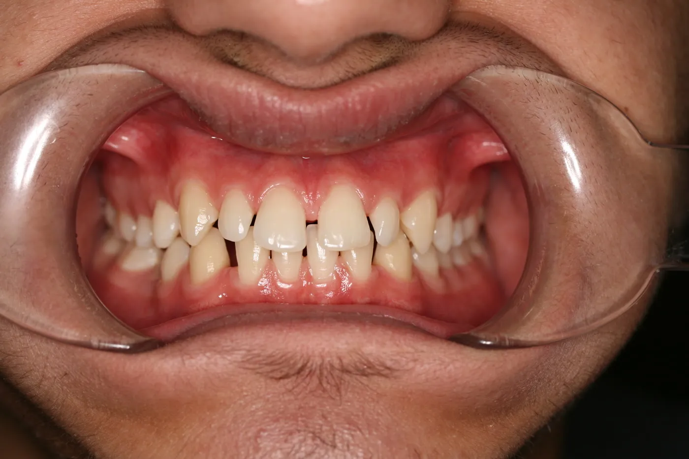 Before treatment: Spacing