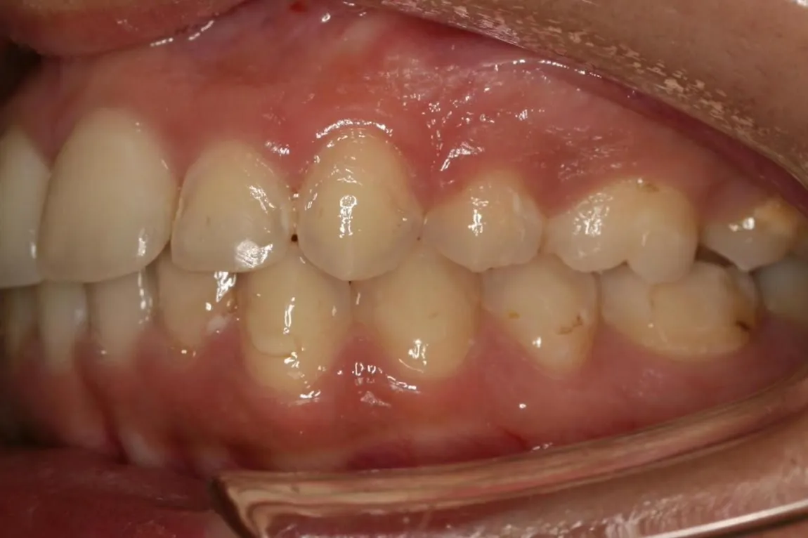 After treatment: Protrusion