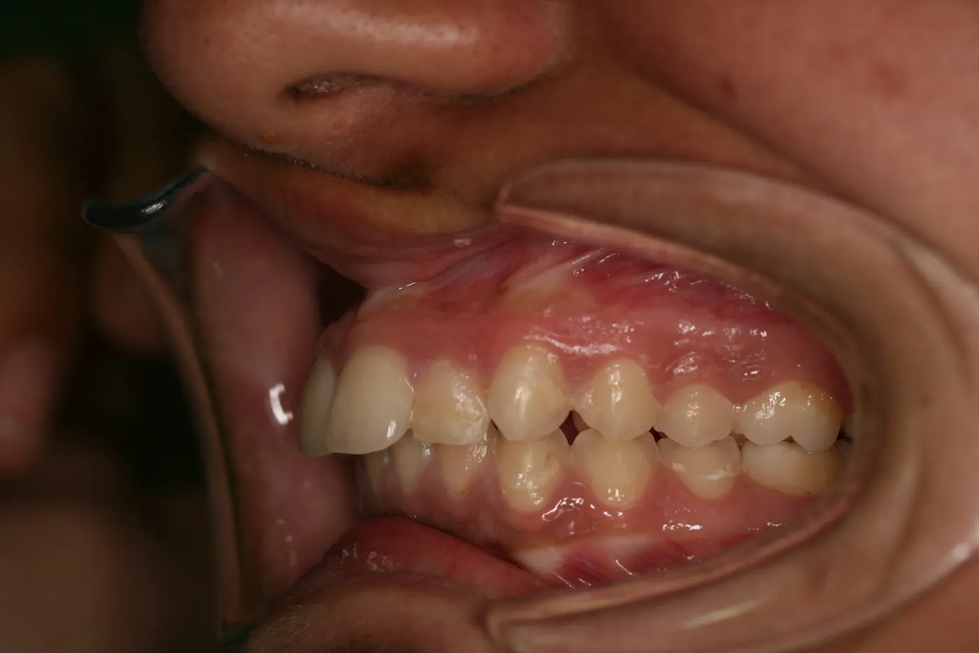 Before treatment: Protrusion