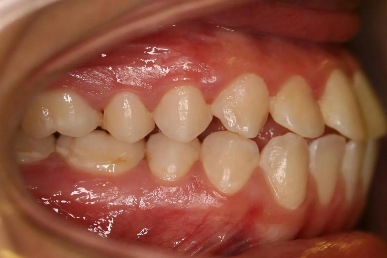 Before treatment: Protrusion