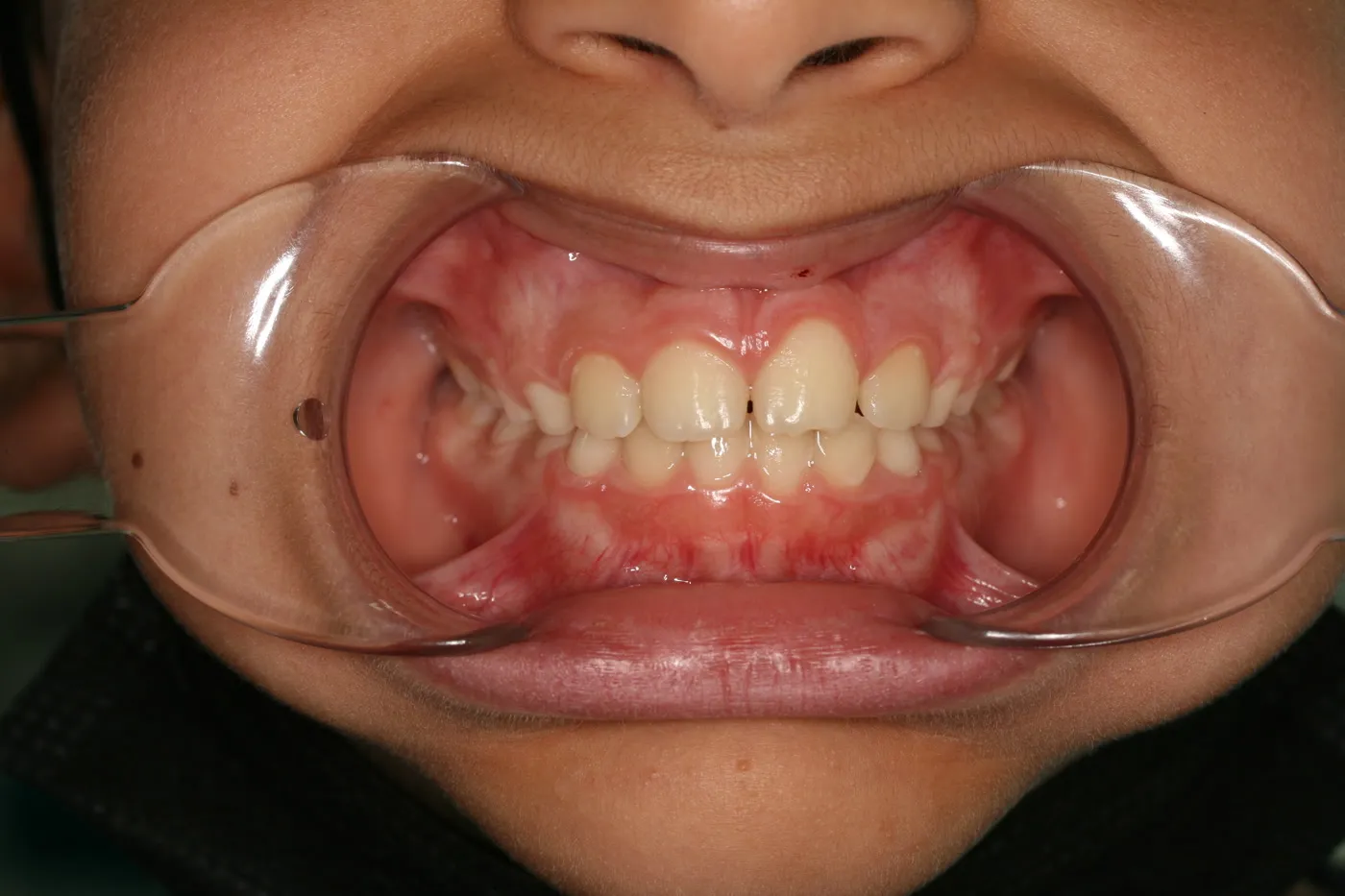 After treatment: Protrusion