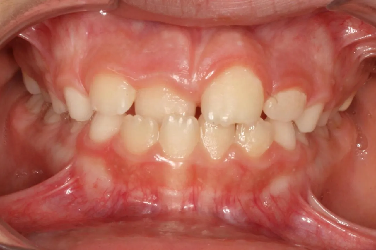 Before treatment: Protrusion