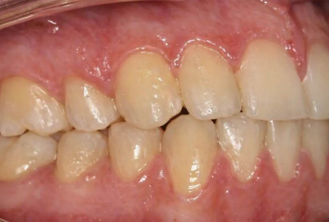 After treatment: Crossbite