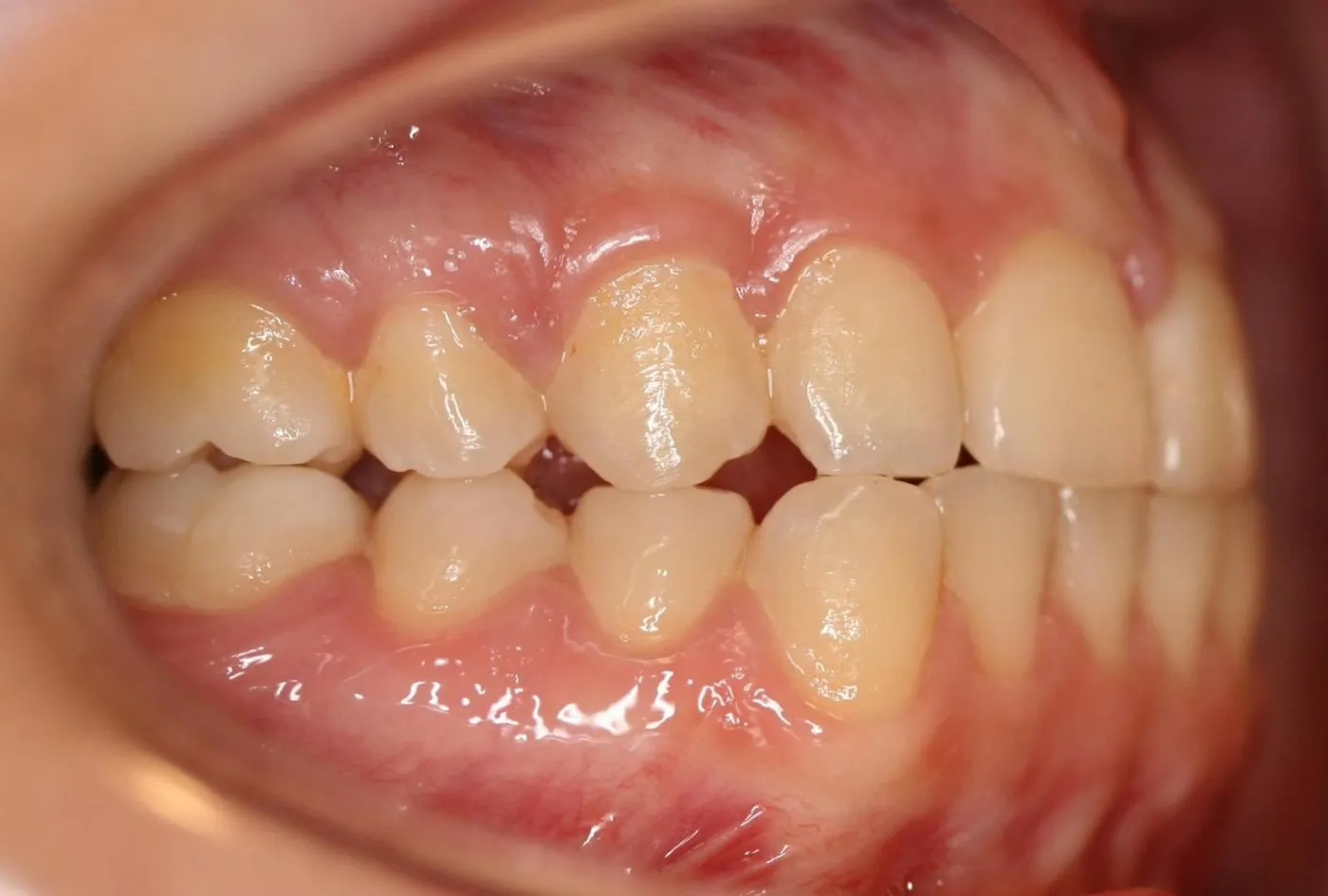 Before treatment: Crossbite