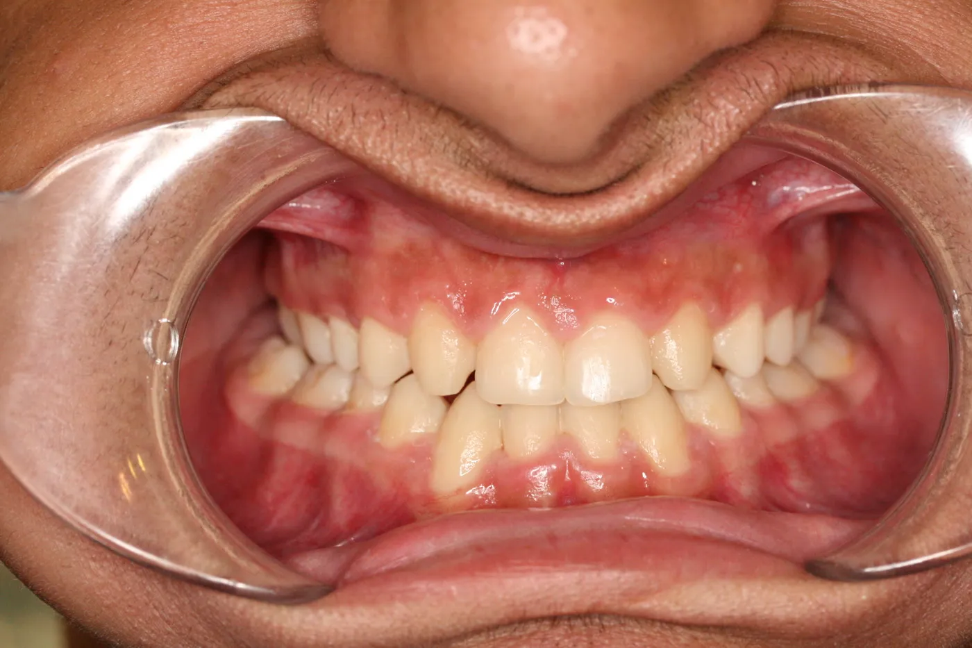 After treatment: Crossbite