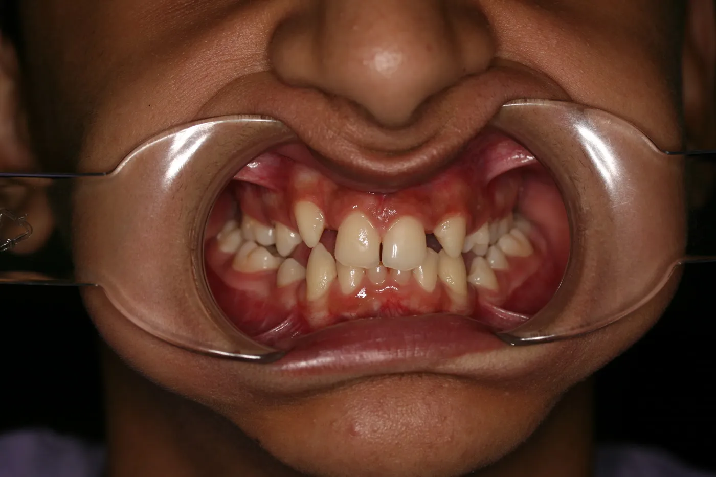 Before treatment: Crossbite