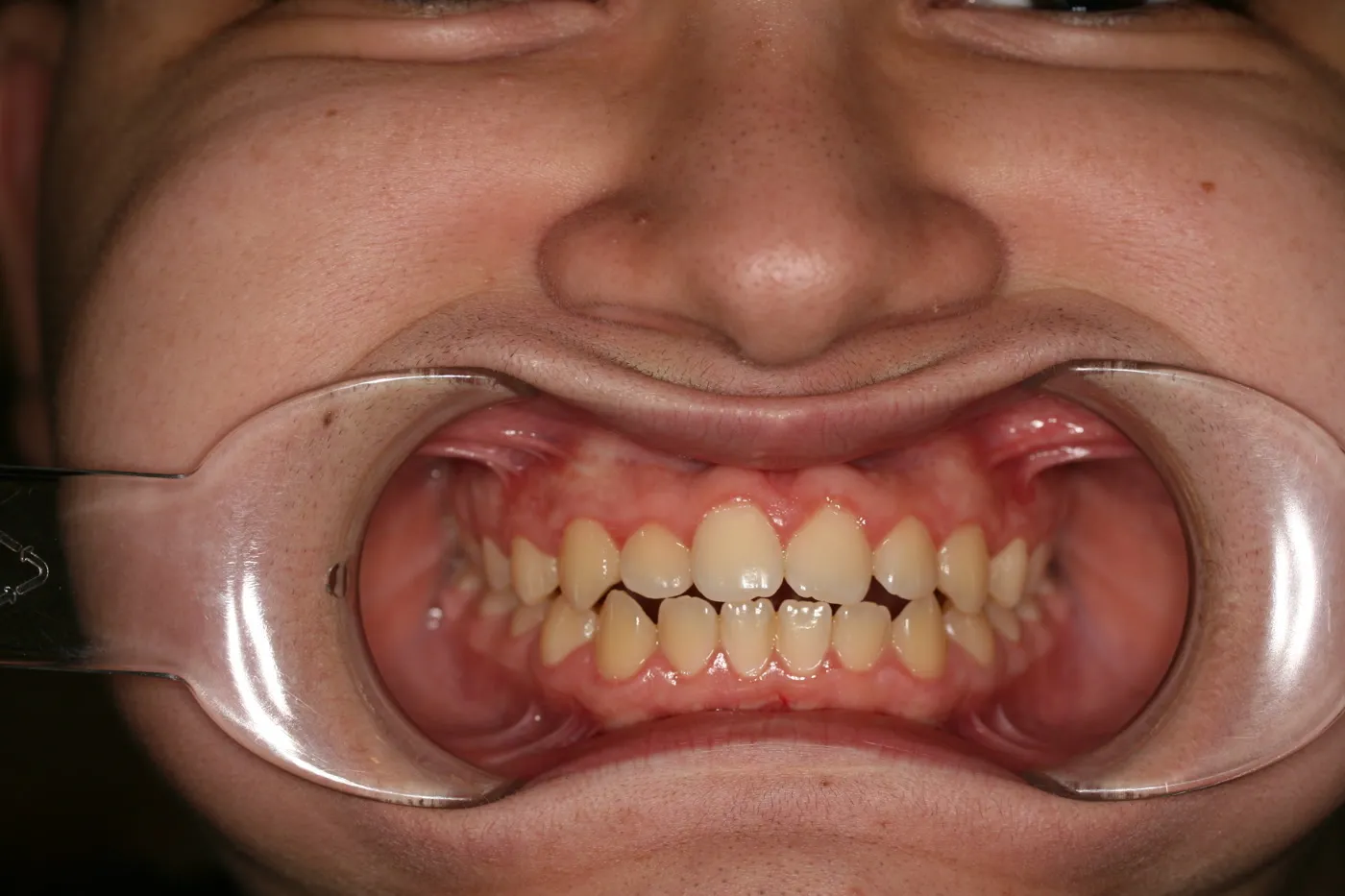 Before treatment: Open bite
