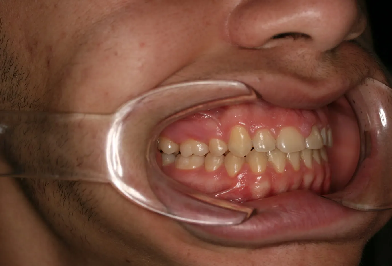After treatment: Other results
