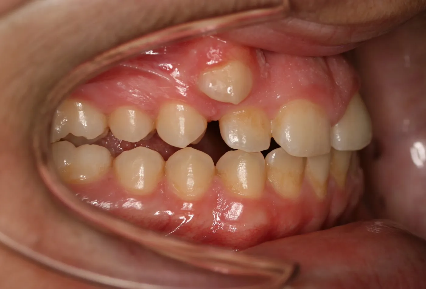 Before treatment: Other results